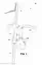 Fig. 02 - Migration resistant embolic filter