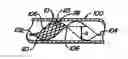 Fig. 01 - ENDOLUMINAL FILTER WITH FIXATION