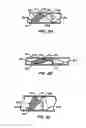 Fig. 03 - ENDOLUMINAL FILTER WITH FIXATION