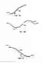 Fig. 06 - ENDOLUMINAL FILTER WITH FIXATION