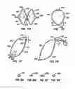 Fig. 07 - ENDOLUMINAL FILTER WITH FIXATION