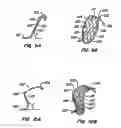 Fig. 08 - ENDOLUMINAL FILTER WITH FIXATION
