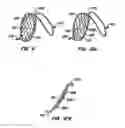Fig. 09 - ENDOLUMINAL FILTER WITH FIXATION