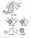 Fig. 47 - ENDOLUMINAL FILTER WITH FIXATION