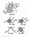 Fig. 48 - ENDOLUMINAL FILTER WITH FIXATION