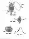 Fig. 50 - ENDOLUMINAL FILTER WITH FIXATION