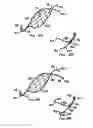 Fig. 53 - ENDOLUMINAL FILTER WITH FIXATION