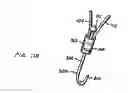 Fig. 63 - ENDOLUMINAL FILTER WITH FIXATION