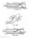 Fig. 65 - ENDOLUMINAL FILTER WITH FIXATION