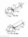 Fig. 68 - ENDOLUMINAL FILTER WITH FIXATION