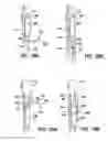 Fig. 77 - ENDOLUMINAL FILTER WITH FIXATION