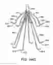 Fig. 84 - ENDOLUMINAL FILTER WITH FIXATION