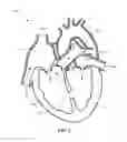 Fig. 03 - EXPANDABLE OCCLUSION DEVICE AND METHODS