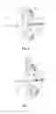Fig. 06 - EXPANDABLE OCCLUSION DEVICE AND METHODS