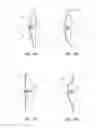 Fig. 15 - EXPANDABLE OCCLUSION DEVICE AND METHODS