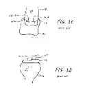 Fig. 03 - Soft tissue fixation using a looped suture construct