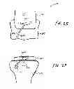 Fig. 06 - Soft tissue fixation using a looped suture construct