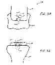 Fig. 07 - Soft tissue fixation using a looped suture construct