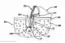 Fig. 01 - Adjustable anchor systems and methods