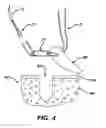 Fig. 04 - Adjustable anchor systems and methods