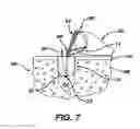 Fig. 07 - Adjustable anchor systems and methods