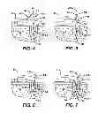 Fig. 03 - Surgical filament snare assemblies