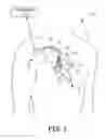 Fig. 02 - Medical electrical lead