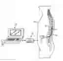 Fig. 01 - System and method for spinal cord modulation to treat motor disorder without paresthesia