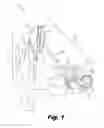 Fig. 02 - Atraumatic electrode lead