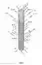 Fig. 02 - Endoprosthesis for implantation in the heart of a patient