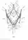 Fig. 08 - Endoprosthesis for implantation in the heart of a patient