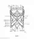 Fig. 31 - Endoprosthesis for implantation in the heart of a patient