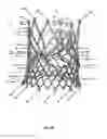 Fig. 46 - Endoprosthesis for implantation in the heart of a patient