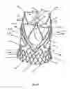 Fig. 49 - Endoprosthesis for implantation in the heart of a patient