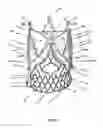 Fig. 50 - Endoprosthesis for implantation in the heart of a patient