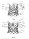 Fig. 57 - Endoprosthesis for implantation in the heart of a patient