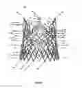 Fig. 59 - Endoprosthesis for implantation in the heart of a patient