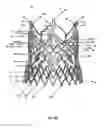 Fig. 60 - Endoprosthesis for implantation in the heart of a patient