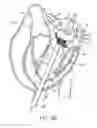 Fig. 22 - Methods and apparatus for delivering a prosthetic valve to a beating heart