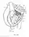 Fig. 35 - Methods and apparatus for delivering a prosthetic valve to a beating heart