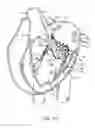 Fig. 40 - Methods and apparatus for delivering a prosthetic valve to a beating heart