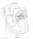 Fig. 45 - Methods and apparatus for delivering a prosthetic valve to a beating heart