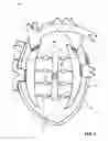 Fig. 04 - ARTIFICIAL HEART