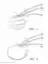 Fig. 02 - Extracellular matrix encasement structures and methods