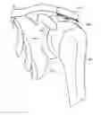 Fig. 01 - Balloon implant device