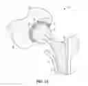 Fig. 02 - CONVERTIBLE ACETABULAR BEARING