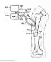 Fig. 01 - SYSTEM AND METHOD FOR PERCUTANEOUSLY ADMINISTERING REDUCED PRESSURE TREATMENT USING A FLOWABLE MANIFOLD