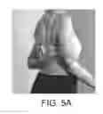 Fig. 09 - Anchoring system for prosthetic and orthotic devices