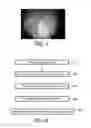 Fig. 04 - OVERLAY AND MOTION COMPENSATION OF STRUCTURES FROM VOLUMETRIC MODALITIES ONTO VIDEO OF AN UNCALIBRATED ENDOSCOPE