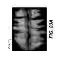 Fig. 32 - Method and system for user interaction in 3-D cephalometric analysis